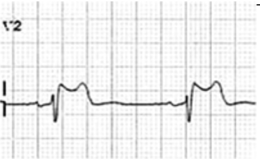 Brugada type 2  